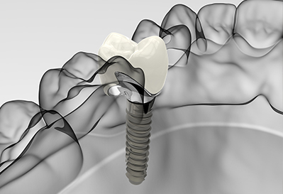 Dental implant